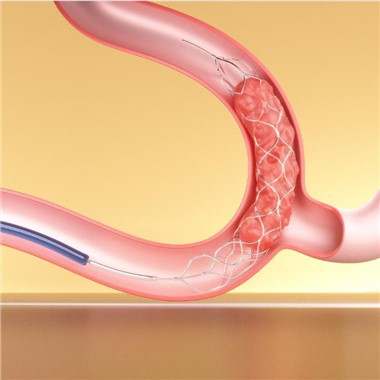 Intrakranielles Stenting
